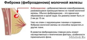 Фиброаденома молочной железы при климаксе