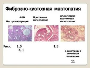 Можно ли ставить мирену при фиброзно кистозной мастопатии
