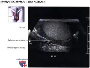 Нормальные размеры придатка яичка на узи