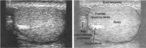 Нормальные размеры придатка яичка на узи