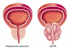 Фуросемид при аденоме предстательной железы