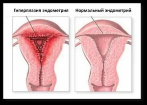 Эндометрий при эндометриозе как улучшить перед эко