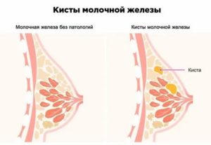 Могут ли рассосаться кисты в молочных железах при климаксе
