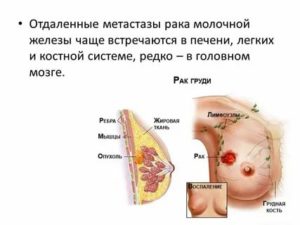 Жидкость в легких причины и лечение при онкологии молочной железы