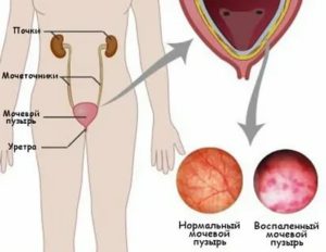 Может ли пиелонефрит вызвать молочницу