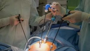 Препараты после лапароскопии маточных труб отзывы