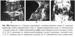 Что такое узи кавернозных тел полового члена