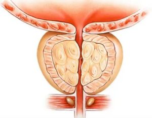 Чага при аденоме простаты механизм действия