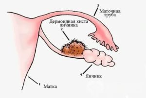 Что такое тератодермоидная киста правого яичника