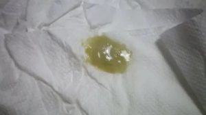 Жидкие выделения при молочнице на 35 неделе беременности