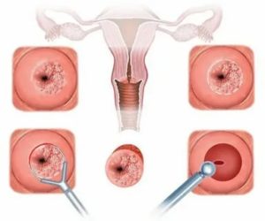 Может ли быть задержка месячных после эрозии шейки матки прижиганием