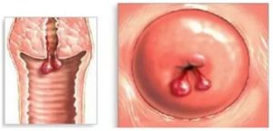 Чем отличаются полипы от кист матки