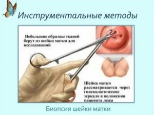 Как лечить прополисом от кисты на шейке матки