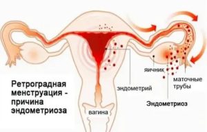 Может ли кровь от месячных попасть в брюшную полость