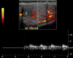 Инфаркт яичка на узи