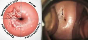 Впч и хроническая молочница