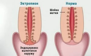 Эктропион клиника лечение диагностика