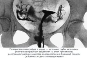 Можно ли по узи определить непроходимость маточных труб