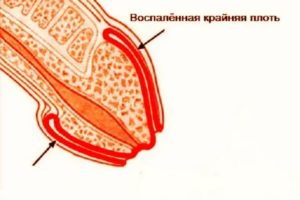 На члене трещины и опухоль