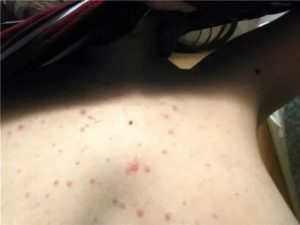 Может ли из за молочницы быть прыщи на теле