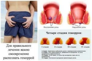 Молочница какать больно