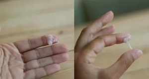 Выделения яичный белок и молочница