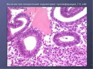 Эндометриоз железистая гиперплазия эндометрия фиброзная