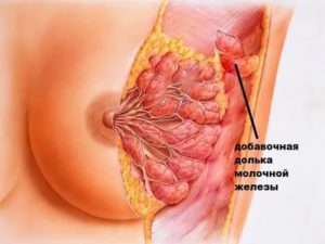 Рак добавочной доли молочной железы