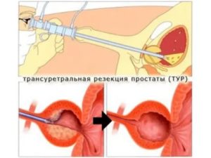 Через какое время после операции по удалению аденомы простаты можно заниматься сексом