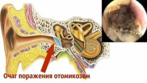 Кандидозный отит наружный