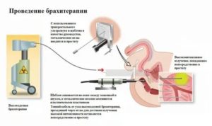 Брахитерапия рака предстательной железы отзывы последствия