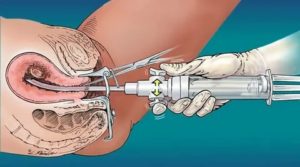 Сколько дней болит живот после гистероскопии матки