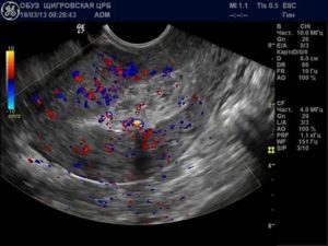 Сгусток крови или полип в матке на узи на