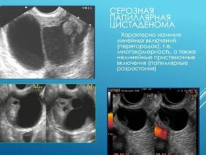 Что такое пристеночные разрастания кисты яичника