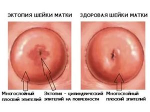 Что такое псевдокиста шейки матки