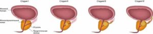 Аденома предстательной железы симптомы и лечение прополисом