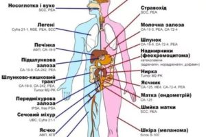 Опухоль яичка онкомаркеры в норме может ли быть рак