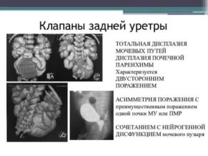 Диагностика клапана задней уретры