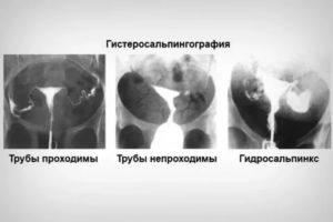 Подготовка к проверке маточных труб на проходимость по узи