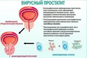 Если у партнера инфекционный простатит