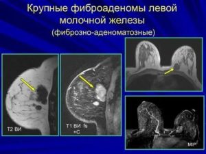 Мрт диагностика фиброаденомы молочной железы