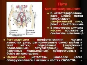 Метастазы в сальнике при раке матки