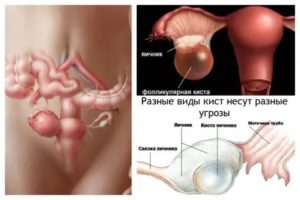 Как узнать есть киста яичника или нет