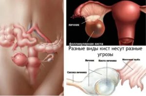 Как избавиться от фолликулярной кисты яичника народными средствами
