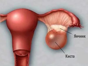 Почему при кисте яичника нельзя загорать