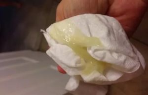 Выделения яичный белок и молочница
