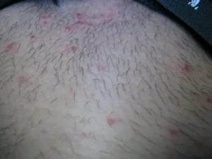 Мазь красные пятна на лобке