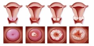 Неоплазия шейки матки это рак