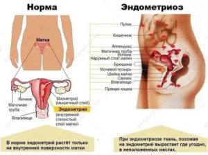 Как вести себя во время месячных при эндометриозе