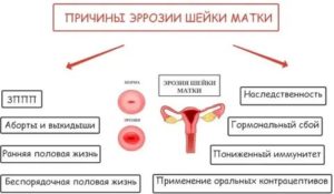 Как лечить и в какой день месячных эрозию шейки матки